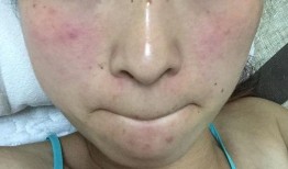 手上吃瓜就起红点,揭秘过敏体质的“瓜果陷阱”